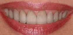 animation showing teeth whitening